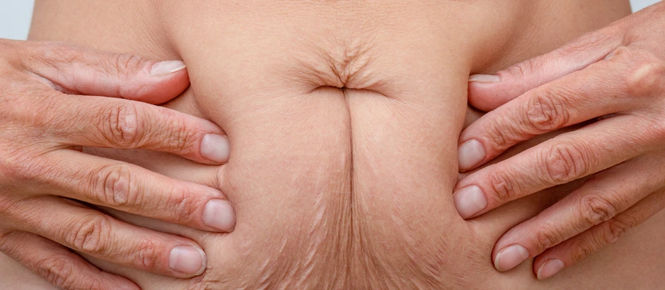 Get Rid of Your Belly Pooch With Emsculpt Neo